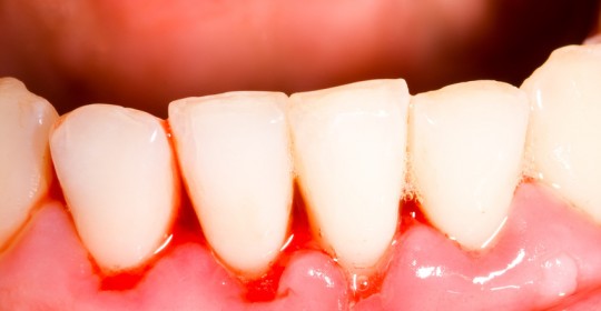 Periodoncia