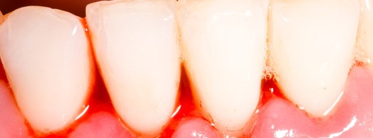 Periodoncia en Alcoy