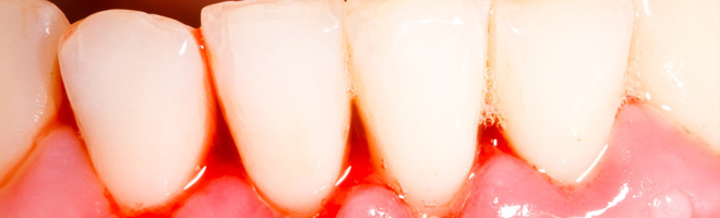 Periodoncia en Alcoy